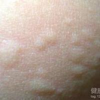 蕁麻疹歌曲歌詞大全_蕁麻疹最新歌曲歌詞